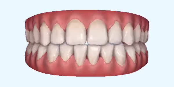 Platinum Invisalign Images
