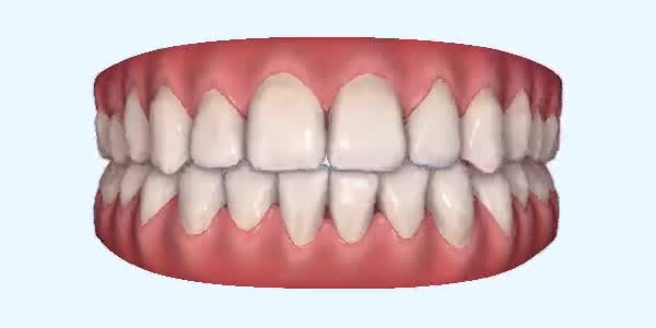 Platinum Invisalign Images