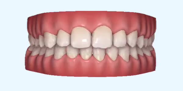 Platinum Invisalign Images