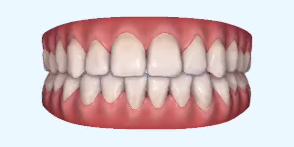 Platinum Invisalign Images