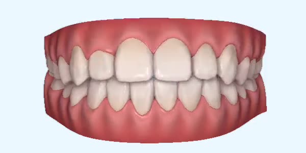 Platinum Invisalign Images