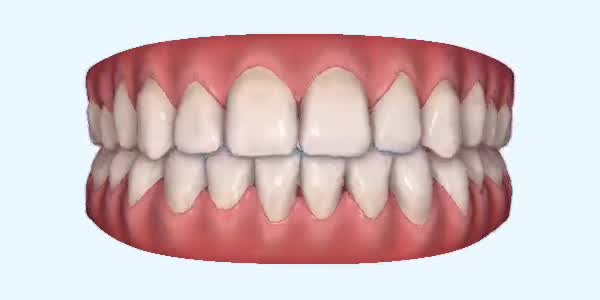 Platinum Invisalign Images
