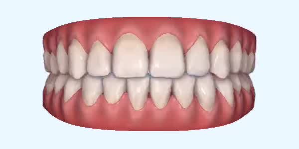 Platinum Invisalign Images