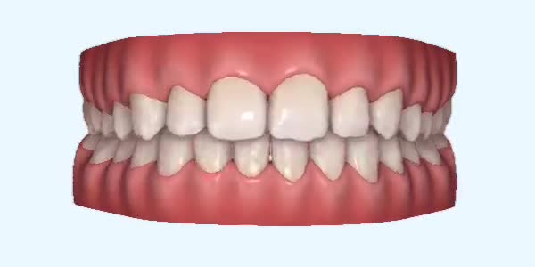 Platinum Invisalign Images