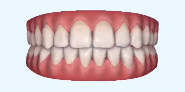 Platinum Invisalign Images
