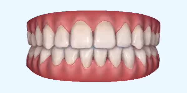 Platinum Invisalign Images