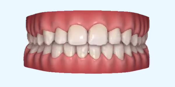 Platinum Invisalign Images