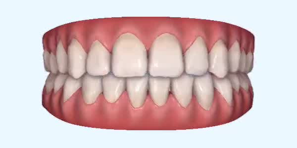 Platinum Invisalign Images