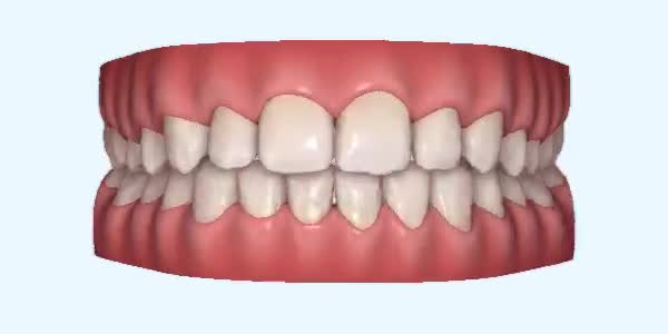 Platinum Invisalign Images