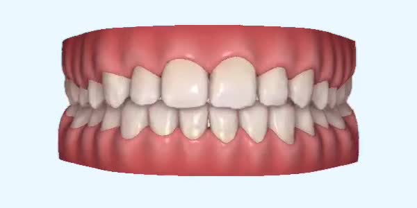 Platinum Invisalign Images